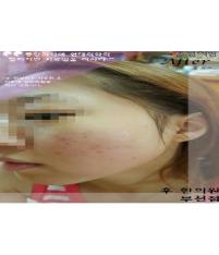 치료 후