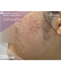 치료 전