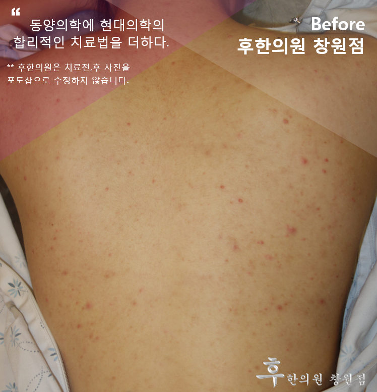 치료 전