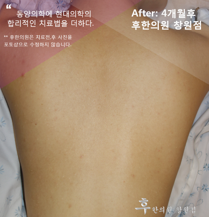 치료 후