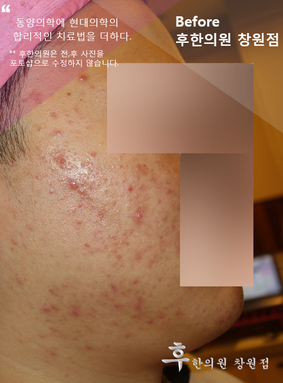 치료 전