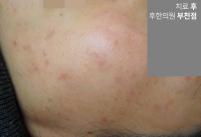 치료 후