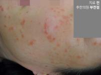 치료 전