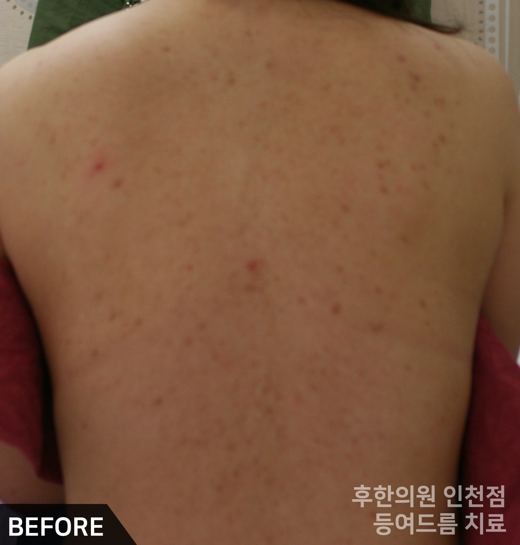 치료 전