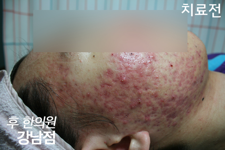 치료 전
