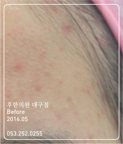 치료 전