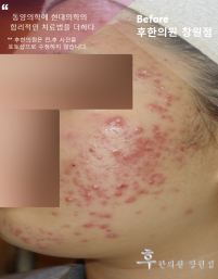 치료 전