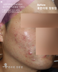 치료 전