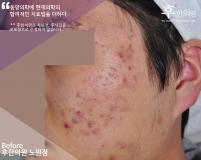 치료 전