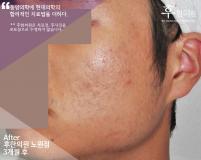 치료 후