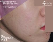치료 후