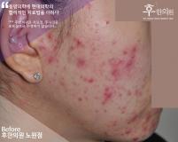 치료 전