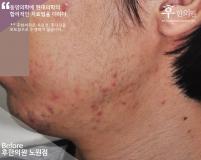 치료 전