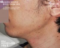 치료 후