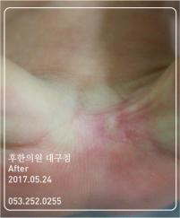 치료 후