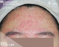 치료 전