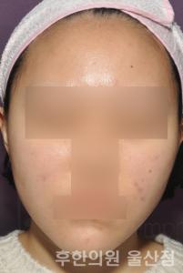 치료 후