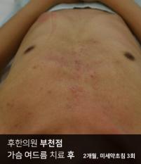 치료 후