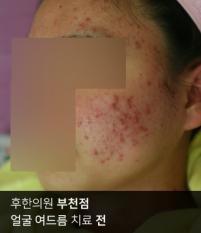 치료 전
