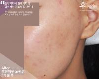 치료 후