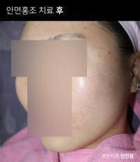 치료 후