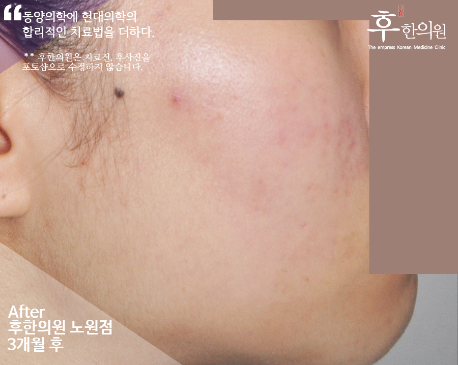 치료 후