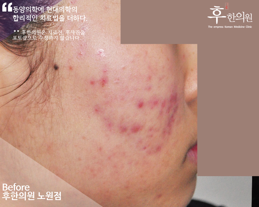 치료 전