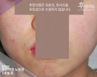 치료 후