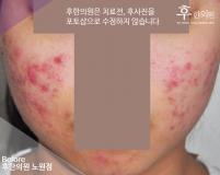 치료 전