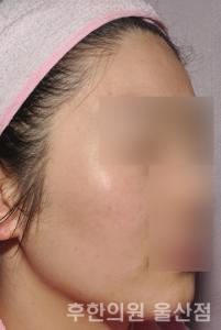 치료 후