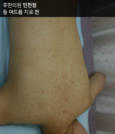 치료 전