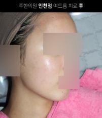 치료 후