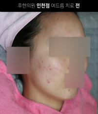 치료 전