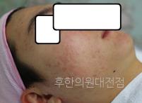 치료 후