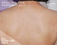 치료 후