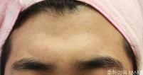 치료 후