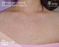 치료 후