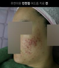 치료 전