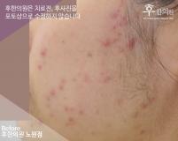 치료 전