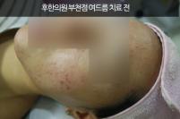 치료 전