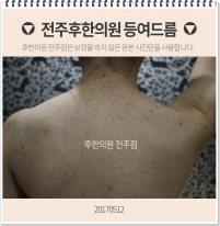 치료 전