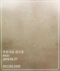 치료 후