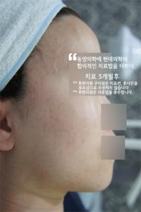 치료 후