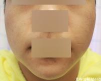 치료 후
