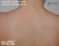 치료 후