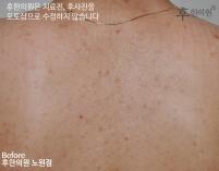 치료 전