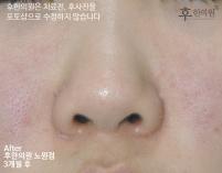 치료 후