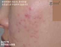 치료 전