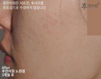 치료 후