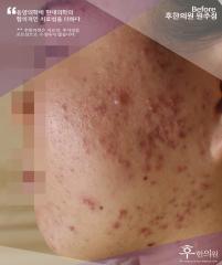 치료 전
